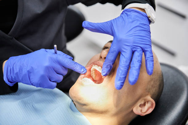 Best Knocked-Out Tooth (Avulsed Tooth) Treatment in Sedro Woolley, WA